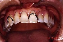 審美義歯治療前（保険義歯）前歯にバネが見える