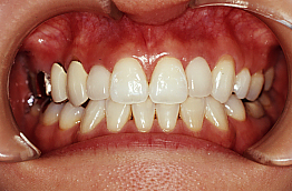 セラミックス治療で自分の歯と同じ様な自然な感じを再現