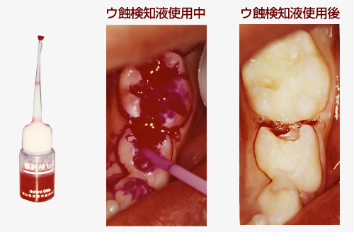 【ウ蝕検知液で取り残しのない虫歯治療】