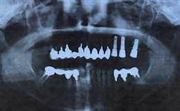 インプラント埋入後のパノラマX線