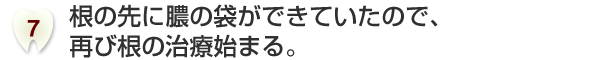 根の先に膿の袋ができていたので、再び根の治療始まる。